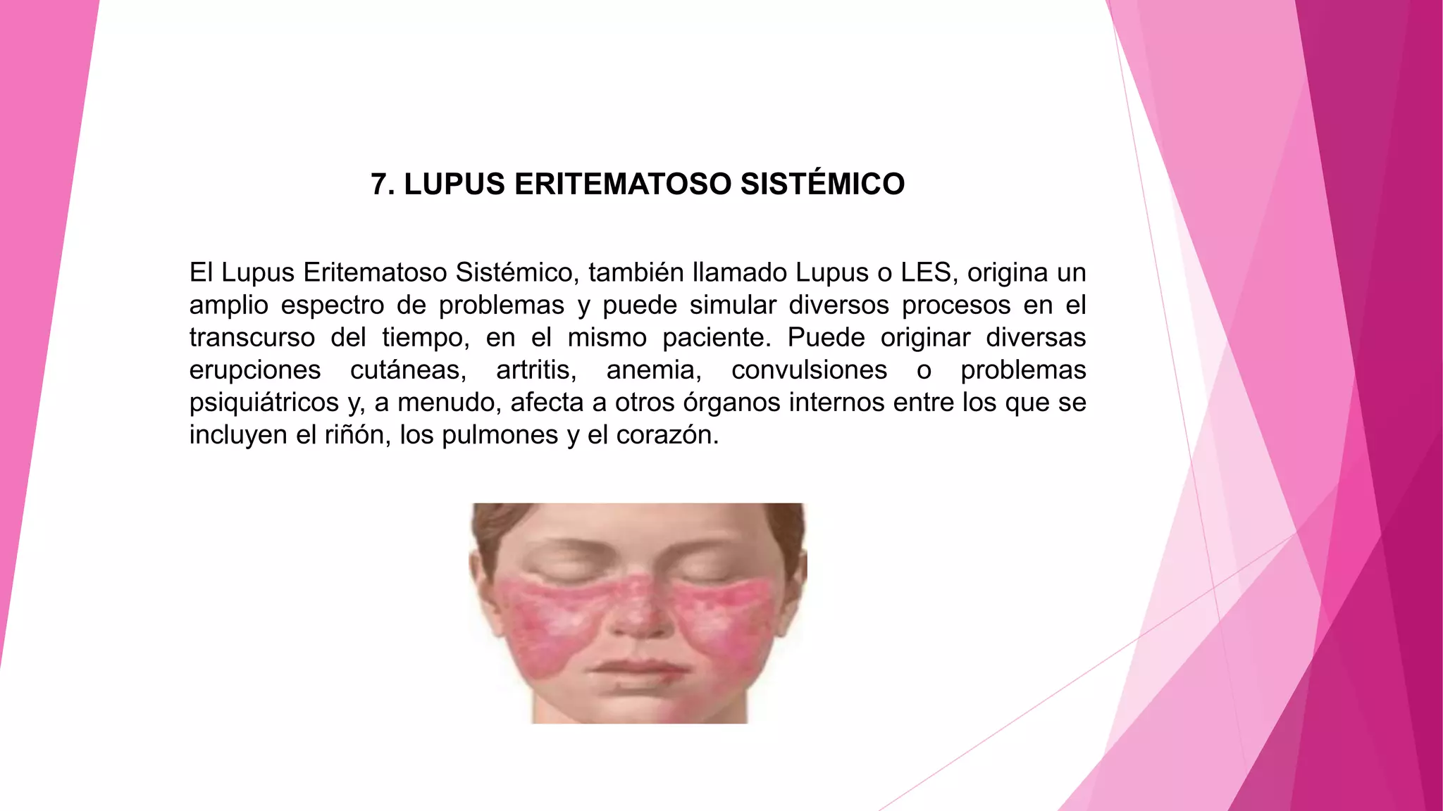7. LUPUS ERITEMATOSO SISTÉMICO
El Lupus Eritematoso Sistémico, también llamado Lupus o LES, origina un
amplio espectro de problemas y puede simular diversos procesos en el
transcurso del tiempo, en el mismo paciente. Puede originar diversas
erupciones cutáneas, artritis, anemia, convulsiones o problemas
psiquiátricos y, a menudo, afecta a otros órganos internos entre los que se
incluyen el riñón, los pulmones y el corazón.
 
