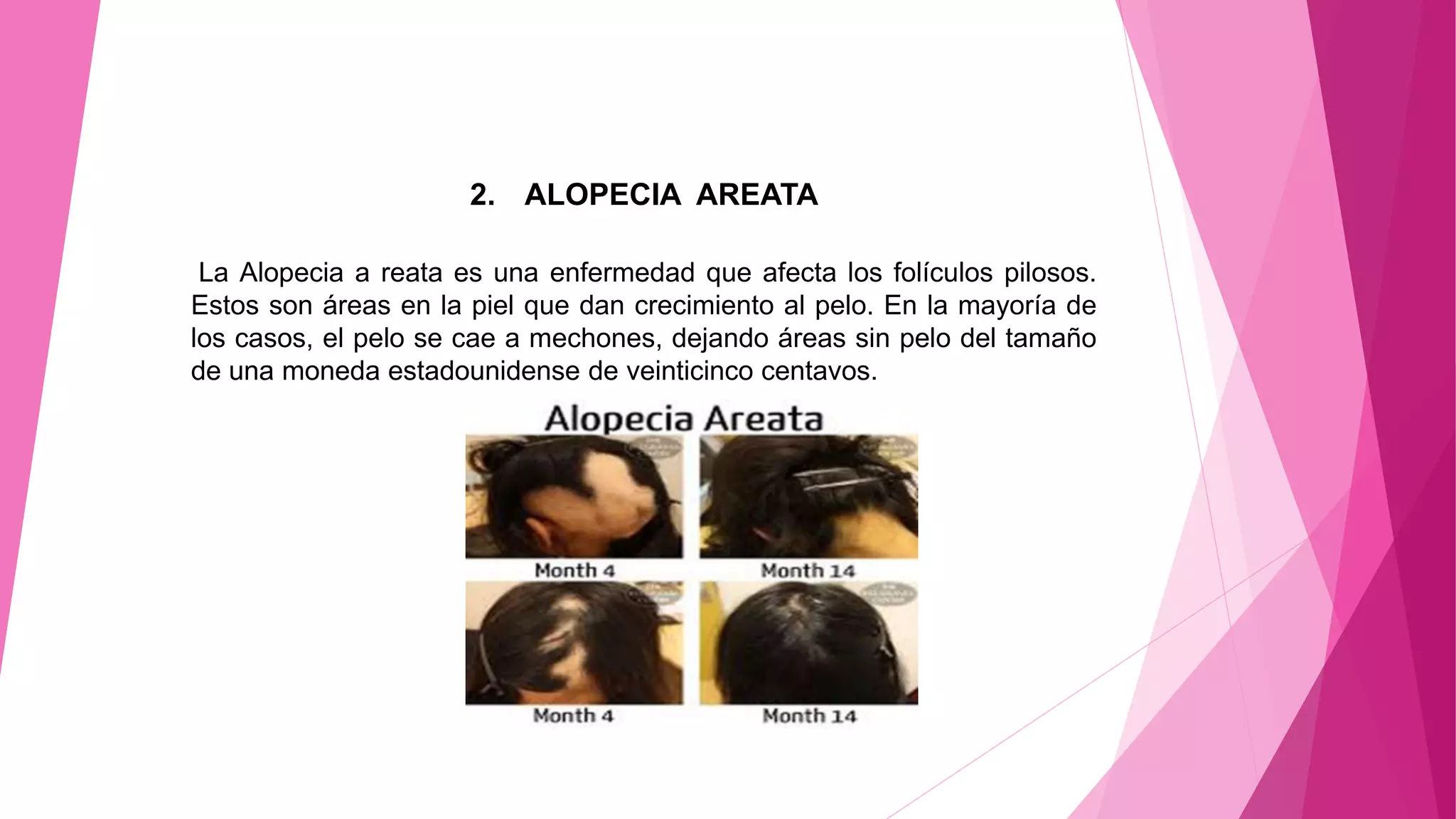 2. ALOPECIA AREATA
La Alopecia a reata es una enfermedad que afecta los folículos pilosos.
Estos son áreas en la piel que dan crecimiento al pelo. En la mayoría de
los casos, el pelo se cae a mechones, dejando áreas sin pelo del tamaño
de una moneda estadounidense de veinticinco centavos.
 