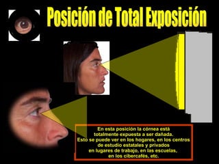 En esta posición la córnea está totalmente expuesta a ser dañada. Esto se puede ver en los hogares, en los centros de estudio estatales y privados en lugares de trabajo, en las escuelas,  en los cibercafés, etc. Posición de Total Exposición  