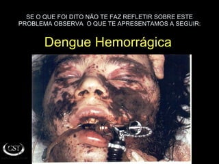 SE O QUE FOI DITO NÃO TE FAZ REFLETIR SOBRE ESTE PROBLEMA OBSERVA  O QUE TE APRESENTAMOS A SEGUIR: Dengue Hemorrágica 