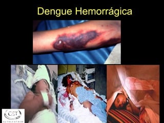 Dengue Hemorrágica 