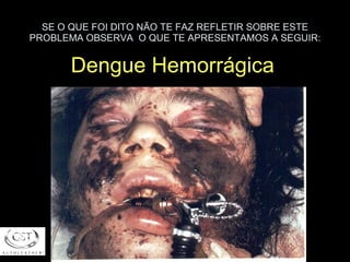 SE O QUE FOI DITO NÃO TE FAZ REFLETIR SOBRE ESTE PROBLEMA OBSERVA  O QUE TE APRESENTAMOS A SEGUIR: Dengue Hemorrágica 