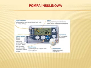 POMPA INSULINOWA
 