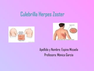 Culebrilla Herpes Zoster
Apellido y Nombre: Espino Micaela
Profesora: Mónica García
 