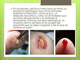  En ocasiones, del foco infeccioso se toma un
producto patologico que se ha formado
durante la infeccion, como el pus, un
esfacelo necrotico u otros. Es el material que
se toma del paciente y se traslada al
laboratorio. Para los estudios serologicos, la
muestra clinica siempre es la sangre del
paciente que se deja coagular y de la que se
obtiene el suero.
 