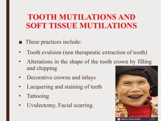 TOOTH MUTILATIONS AND
SOFT TISSUE MUTILATIONS
■ These practices include:
• Tooth evulsion (non therapeutic extraction of tooth)
• Alterations in the shape of the tooth crown by filling
and chipping
• Decorative crowns and inlays
• Lacquering and staining of teeth
• Tattooing
• Uvulectomy, Facial scarring.
66
 