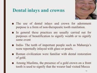 Dental inlays and crowns
■ The use of dental inlays and crown for adornment
purpose is a form of non-therapeutic tooth mutilation.
■ In general these practices are usually carried out for
purposes of beautification to signify wealth or to signify
some event
■ India- The teeth of important people such as Maharaja’s
were reportedly inlayed with glass or pearls.
■ Roman civilization were familiar with dental restoration
of gold.
■ Among Muslims, the presence of a gold crown on a front
tooth is used to signify that the wearer had visited Mecca
70
 