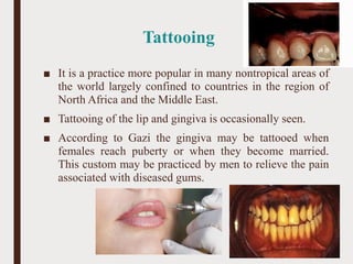 Tattooing
■ It is a practice more popular in many nontropical areas of
the world largely confined to countries in the region of
North Africa and the Middle East.
■ Tattooing of the lip and gingiva is occasionally seen.
■ According to Gazi the gingiva may be tattooed when
females reach puberty or when they become married.
This custom may be practiced by men to relieve the pain
associated with diseased gums.
71
 