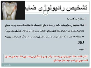 ‫گزیمال‬‫و‬‫پر‬‫سطوح‬:
‫په‬ ‫قاعده‬ ‫با‬ ‫مثلث‬ ‫یک‬‫کالسیک‬ ‫ر‬‫طو‬ ‫به‬ ‫مینا‬ ‫در‬ ‫اولیه‬ ‫ادیولوسنت‬‫ر‬ ‫ضایعه‬‫شکل‬‫سطح‬ ‫در‬ ‫ن‬
‫یابد‬‫می‬ ‫انتشار‬ ‫مینایی‬ ‫های‬ ‫میله‬ ‫امتداد‬ ‫در‬ ‫که‬ ‫است‬ ‫دندان‬.‫مثل‬ ‫ی‬‫دیگر‬ ‫نماهای‬ ‫اما‬‫بریدگی‬
–‫نقطه‬–‫دمینرالیزاس‬‫اگر‬ ‫شود‬‫می‬ ‫پخش‬ ‫امتداداتصال‬‫ر‬‫د‬ ‫ظریف‬ ‫خط‬ ‫یک‬ ‫یا‬ ‫باند‬‫به‬ ‫ن‬‫یو‬
DEJ
‫برسد‬
atousa.chd
 