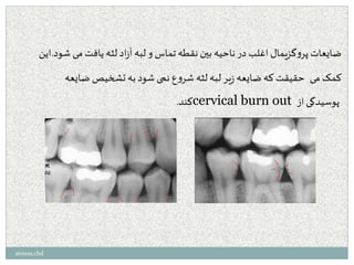 ‫شود‬ ‫می‬‫یافت‬ ‫لثه‬ ‫اد‬‫ز‬‫آ‬ ‫لبه‬ ‫و‬ ‫تماس‬ ‫نقطه‬ ‫بین‬ ‫ناحیه‬‫در‬ ‫اغلب‬ ‫گزیمال‬‫و‬‫پر‬ ‫ضایعات‬.‫این‬
‫ضایعه‬ ‫تشخیص‬ ‫به‬ ‫شود‬ ‫نمی‬ ‫ع‬‫و‬‫شر‬ ‫لثه‬ ‫لبه‬ ‫یر‬‫ز‬ ‫ضایعه‬ ‫که‬ ‫حقیقت‬ ‫می‬ ‫کمک‬
‫کند‬. cervical burn out ‫از‬ ‫پوسیدگی‬
atousa.chd
 