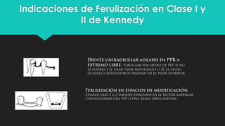 Indicaciones de Ferulización en Clase I y
II de Kennedy
 