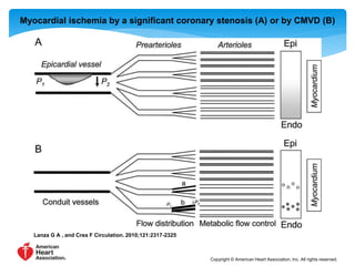 Myocardial ischemia by a significant coronary stenosis (A) or by CMVD (B) 
Lanza G A , and Crea F Circulation. 2010;121:2317-2325 
Copyright © American Heart Association, Inc. All rights reserved. 
 