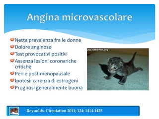 Netta prevalenza fra le donne 
Dolore anginoso 
Test provocativi positivi 
Assenza lesioni coronariche 
critiche 
Peri e post-menopausale 
Ipotesi: carenza di estrogeni 
Prognosi generalmente buona 
Reynolds. Circulation 2011; 124: 1414-1425 
 