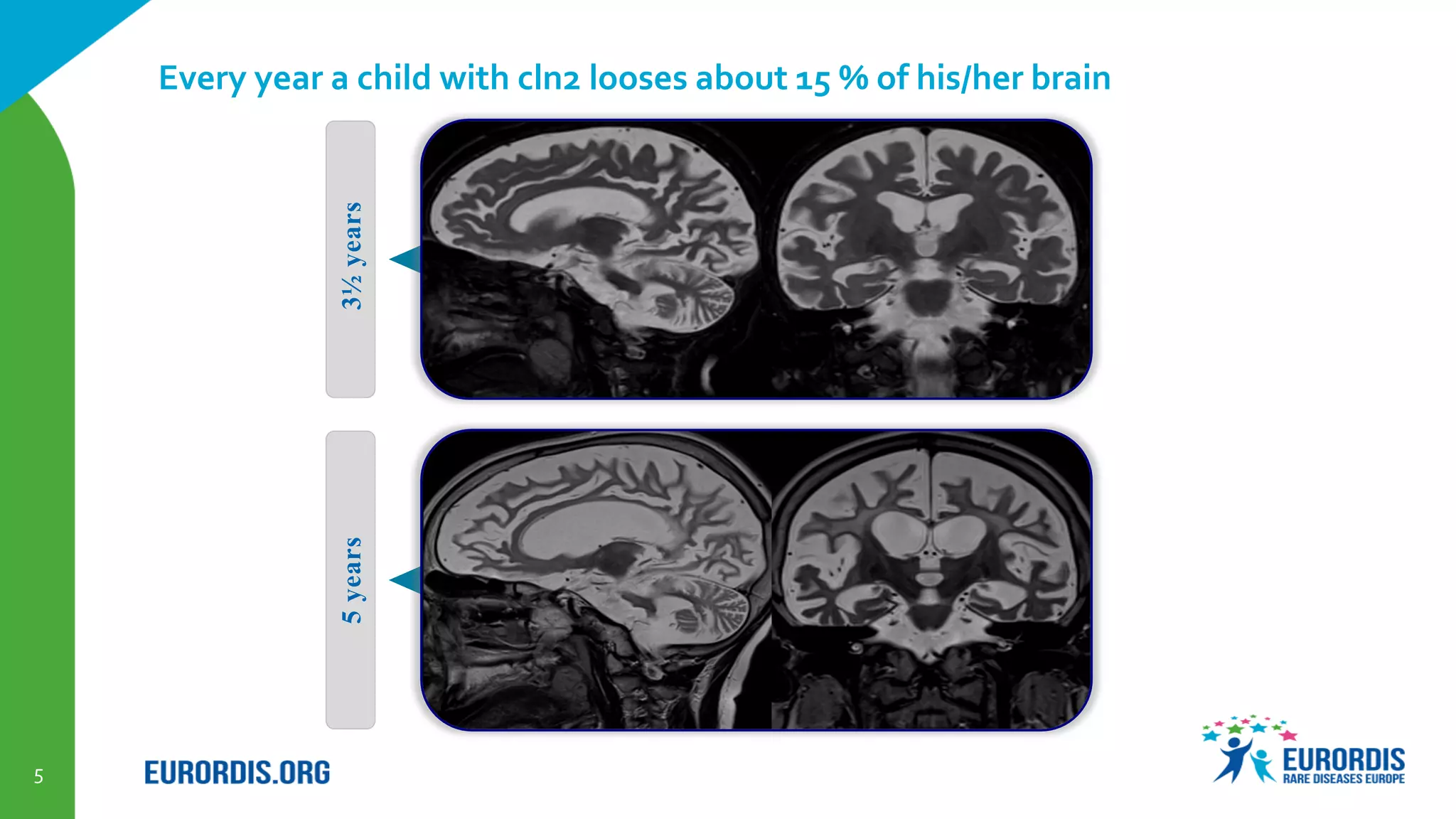 5
Every year a child with cln2 looses about 15 % of his/her brain
3½years5years
 