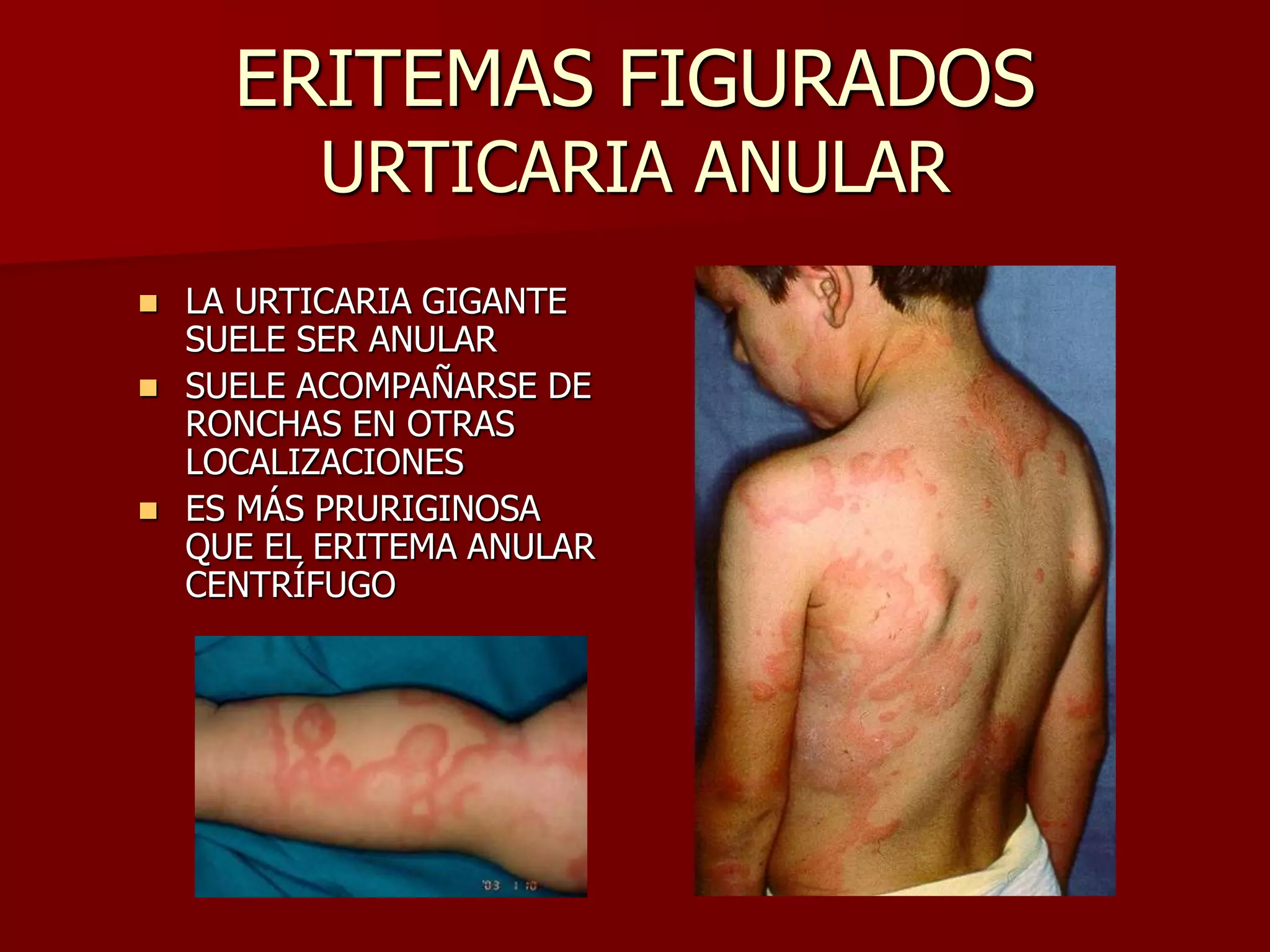 Eritema Anular Centrífugo: Viejas Enfermedades, Nuevos Conceptos – VFZOI