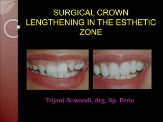 SURGICAL CROWN
LENGTHENING IN THE ESTHETIC
ZONE
Trijani Suwandi, drg, Sp. Perio
 