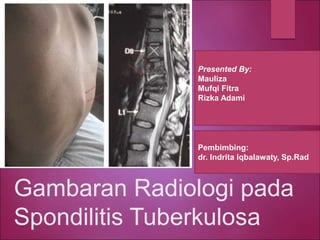 Gambaran Radiologi pada
Spondilitis Tuberkulosa
Presented By:
Mauliza
Mufqi Fitra
Rizka Adami
Pembimbing:
dr. Indrita Iqbalawaty, Sp.Rad
 