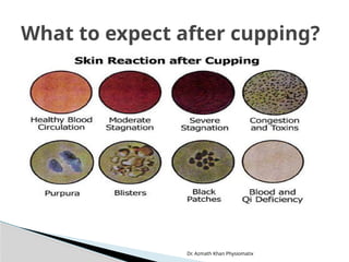 Dr. Azmath Khan Physiomatix
What to expect after cupping?
 