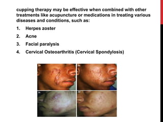 cupping therapy may be effective when combined with other
treatments like acupuncture or medications in treating various
diseases and conditions, such as:
1. Herpes zoster
2. Acne
3. Facial paralysis
4. Cervical Osteoarthritis (Cervical Spondylosis)
 