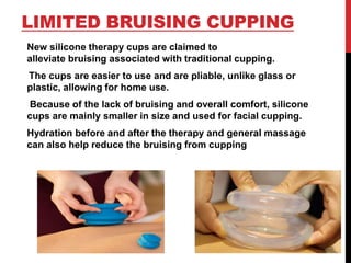 LIMITED BRUISING CUPPING
New silicone therapy cups are claimed to
alleviate bruising associated with traditional cupping.
The cups are easier to use and are pliable, unlike glass or
plastic, allowing for home use.
Because of the lack of bruising and overall comfort, silicone
cups are mainly smaller in size and used for facial cupping.
Hydration before and after the therapy and general massage
can also help reduce the bruising from cupping
 