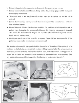    Explain to the patient what you about to do, demonstrate if necessary on your own arm
   In order to achieve better contact between the cup and the skin, liberally apply a suitable massage oil
    to the cupping intended area
   The selected areas of skin may be shaved, so that a good seal between the cup and skin can be
    achieved.
   Patients about to undergo cupping (especially the wet version) should be advised to take a nutritional
    drink before the cupping.
   Pressure applied to cups will vary according to patients. For medium to large frame patients, and in
    patients where the cupping sites are endowed with excess fatty tissue, the pressure can be increased.
    This ensures that the area beneath the glass will respond at a faster rate than on patients who are
    leaner, and with less fatty tissue.
   Cupping can also be carried out in parallel to massage. Choose the best position suitable for the
    patient and you as sudden movements are not recommended


The location to be treated is important in deciding the position of the patient. If the cupping is to be
performed on the back, the most comfortable position will be prone on a bed or flat surface area; if on
the stomach, a supine position is preferred. For the face, knees, neck and shoulders, a sitting position in
a chair may be chosen. For the elderly, severe asthmatics or patients who have recently suffered form
any heart conditions, an upright sitting position should always be preferred, see figures A-F.




                                                                                                        10
 