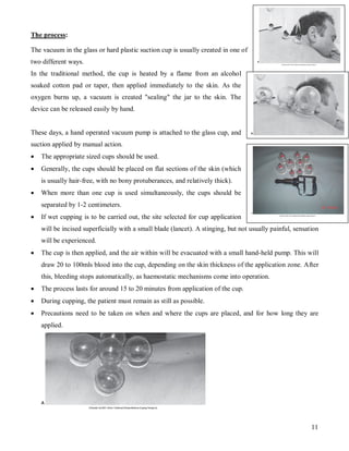 The process:

The vacuum in the glass or hard plastic suction cup is usually created in one of
two different ways.
In the traditional method, the cup is heated by a flame from an alcohol
soaked cotton pad or taper, then applied immediately to the skin. As the
oxygen burns up, a vacuum is created "sealing" the jar to the skin. The
device can be released easily by hand.


These days, a hand operated vacuum pump is attached to the glass cup, and
suction applied by manual action.
   The appropriate sized cups should be used.
   Generally, the cups should be placed on flat sections of the skin (which
    is usually hair-free, with no bony protuberances, and relatively thick).
   When more than one cup is used simultaneously, the cups should be
    separated by 1-2 centimeters.
   If wet cupping is to be carried out, the site selected for cup application
    will be incised superficially with a small blade (lancet). A stinging, but not usually painful, sensation
    will be experienced.
   The cup is then applied, and the air within will be evacuated with a small hand-held pump. This will
    draw 20 to 100mls blood into the cup, depending on the skin thickness of the application zone. After
    this, bleeding stops automatically, as haemostatic mechanisms come into operation.
   The process lasts for around 15 to 20 minutes from application of the cup.
   During cupping, the patient must remain as still as possible.
   Precautions need to be taken on when and where the cups are placed, and for how long they are
    applied.




                                                                                                          11
 