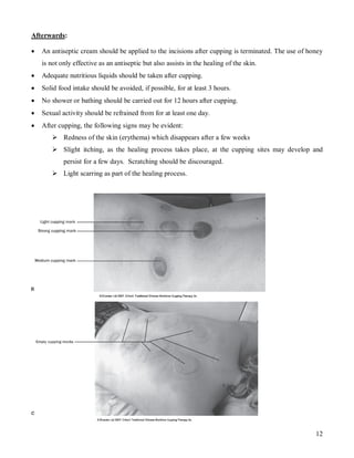 Afterwards:

   An antiseptic cream should be applied to the incisions after cupping is terminated. The use of honey
    is not only effective as an antiseptic but also assists in the healing of the skin.
   Adequate nutritious liquids should be taken after cupping.
   Solid food intake should be avoided, if possible, for at least 3 hours.
   No shower or bathing should be carried out for 12 hours after cupping.
   Sexual activity should be refrained from for at least one day.
   After cupping, the following signs may be evident:
        Redness of the skin (erythema) which disappears after a few weeks
        Slight itching, as the healing process takes place, at the cupping sites may develop and
            persist for a few days. Scratching should be discouraged.
        Light scarring as part of the healing process.




                                                                                                     12
 