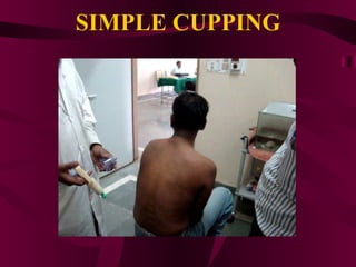 SIMPLE CUPPING 