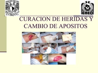 CURACION DE HERIDAS Y
 CAMBIO DE APOSITOS
 