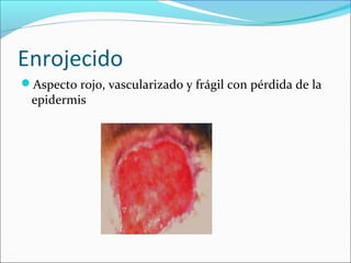 Enrojecido 
Aspecto rojo, vascularizado y frágil con pérdida de la 
epidermis 
 