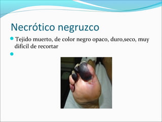 Necrótico negruzco 
Tejido muerto, de color negro opaco, duro,seco, muy 
difícil de recortar 
 
 