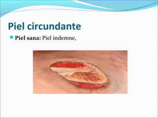 Piel circundante 
Piel sana: Piel indemne, 
 