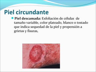 Piel circundante 
Piel descamada: Exfoliación de células de 
tamaño variable, color plateado, blanco o tostado 
que indica sequedad de la piel y propensión a 
grietas y fisuras, 
 