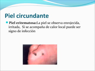 Piel circundante 
Piel eritematosa:La piel se observa enrojecida, 
irritada, Si se acompaña de calor local puede ser 
signo de infección 
 