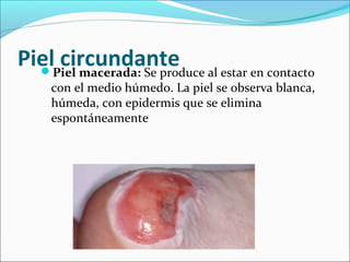 Piel circundante 
Piel macerada: Se produce al estar en contacto 
con el medio húmedo. La piel se observa blanca, 
húmeda, con epidermis que se elimina 
espontáneamente 
 