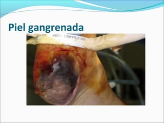 Piel gangrenada 
 