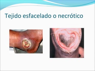 Tejido esfacelado o necrótico 
 
