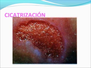 CICATRIZACIÓN 
 