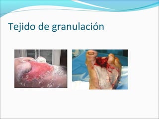 Tejido de granulación 
 