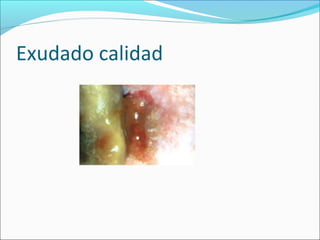 Exudado calidad 
 