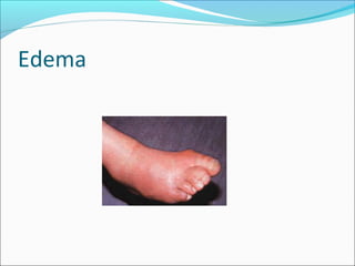 Edema 
 