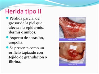 Herida tipo II 
Pérdida parcial del 
grosor de la piel que 
afecta a la epidermis, 
dermis o ambos. 
Aspecto de abrasión, 
ampolla. 
Se presenta como un 
orificio tapizado con 
tejido de granulación o 
fibrina. 
 