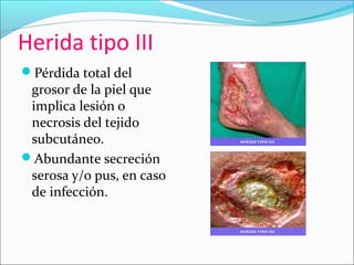 Herida tipo III 
Pérdida total del 
grosor de la piel que 
implica lesión o 
necrosis del tejido 
subcutáneo. 
Abundante secreción 
serosa y/o pus, en caso 
de infección. 
 