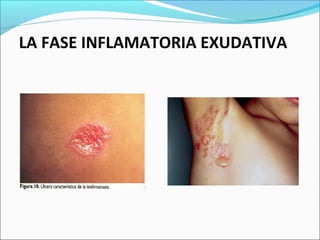 LA FASE INFLAMATORIA EXUDATIVA 
 