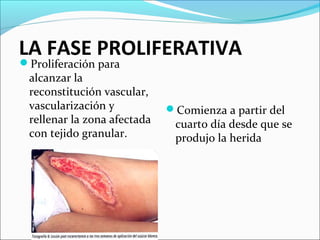 LA FASE PROLIFERATIVA 
Proliferación para 
alcanzar la 
reconstitución vascular, 
vascularización y 
rellenar la zona afectada 
con tejido granular. 
Comienza a partir del 
cuarto día desde que se 
produjo la herida 
 