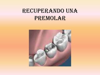 RECUPERANDO UNA
PREMOLAR
 