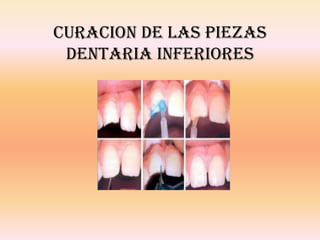CURACION DE LAS PIEZAS
DENTARIA INFERIORES
 