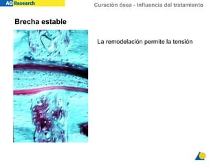 Curación ósea - Influencia del tratamiento
La remodelación permite la tensión
Brecha estable
 
