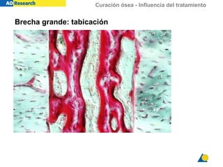 Curación ósea - Influencia del tratamiento
Brecha grande: tabicación
 