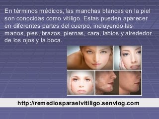 http://remediosparaelvitiligo.senvlog.com/
En términos médicos, las manchas blancas en la piel
son conocidas como vitiligo. Estas pueden aparecer
en diferentes partes del cuerpo, incluyendo las
manos, pies, brazos, piernas, cara, labios y alrededor
de los ojos y la boca.
 